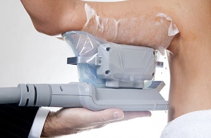 fat freezing arms Grimsby