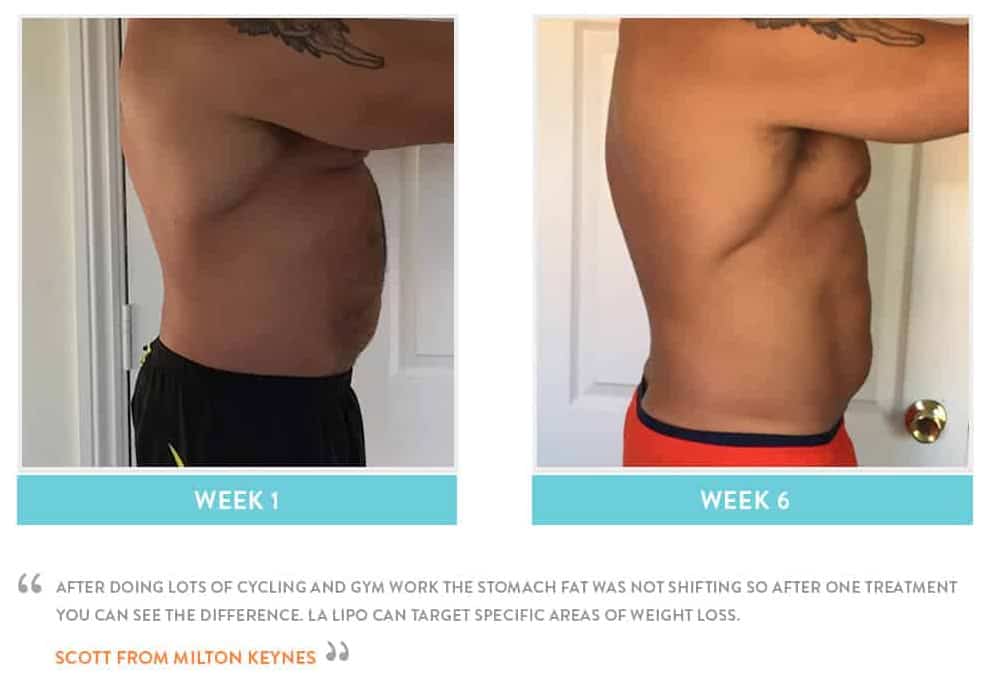 Before & After Stomach Fat Grimsby