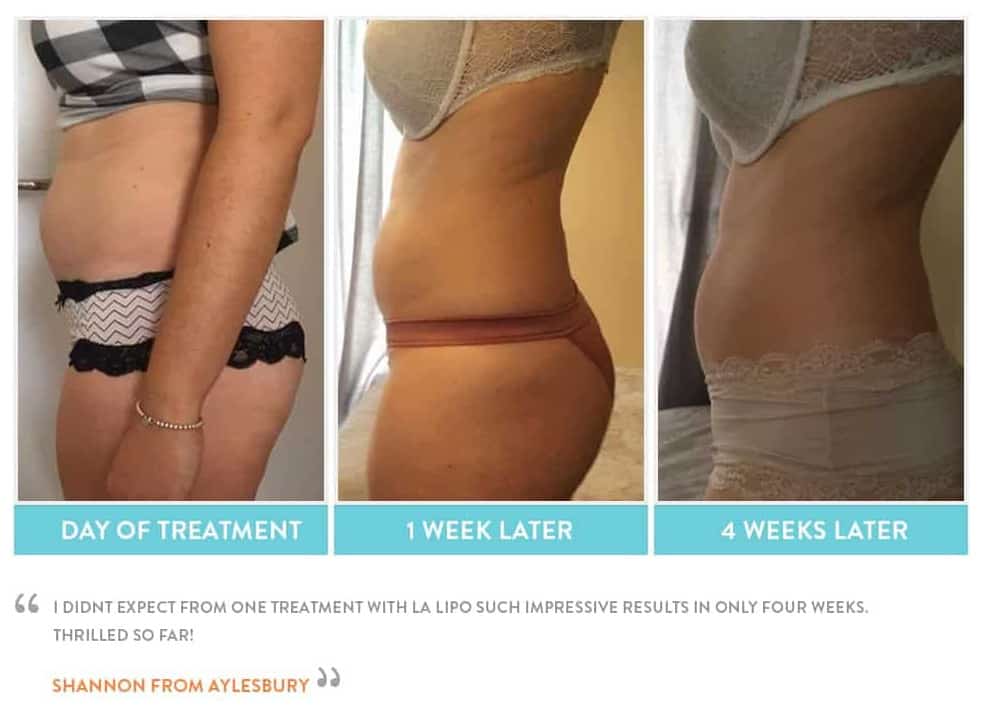 before, Cryolipolysis Grimsby