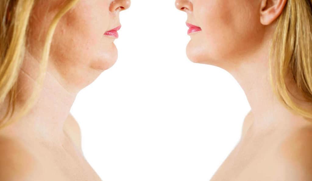 Double Chin treatment Grimsby before and after results