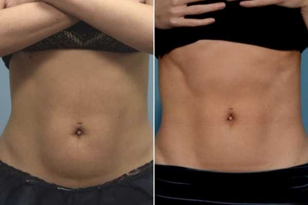 body sculpting FAQs Grimsby