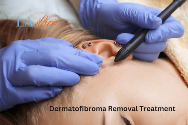 Dermatofibroma Removal Treatment Grimsby