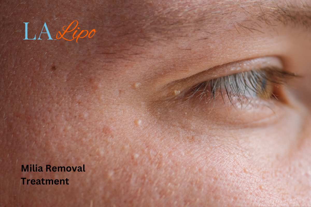 Cryopen Milia Removal: Is It the Easiest and Safest Option Grimsby?