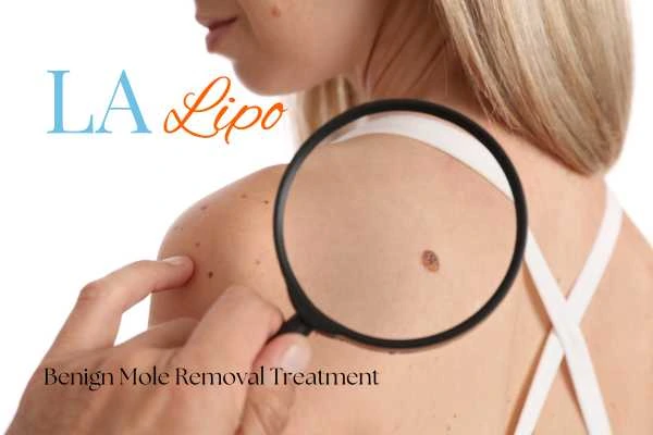 Woman having her inspection of blemish before mole removal Grimsby