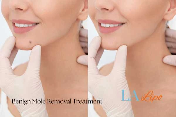 Before and after mole removal Grimsby treatment