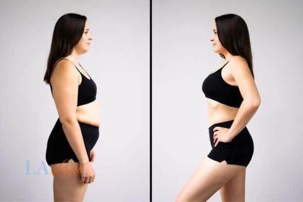 image of woman before and after results of LA-EMS Body Sculpting Grimsby to help treat Diastasis recti
