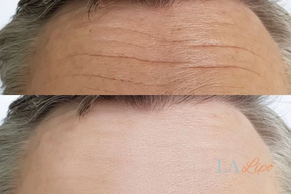 results of HIFU Grimsby on mans forehead to help reduce lines and wrinkles