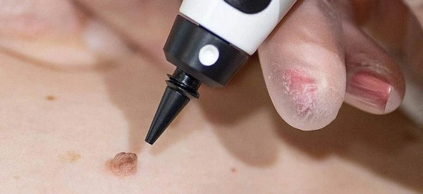 skin tag removal using cryopen Grimsby