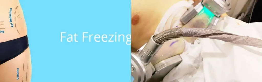 multi areas of a persons body having coolsculpting Grimsby treatment