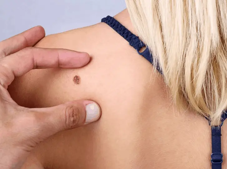 woman having mole removal Grimsby consultation before treatment.