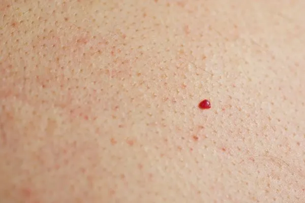 close up of a cherry angioma Grimsby