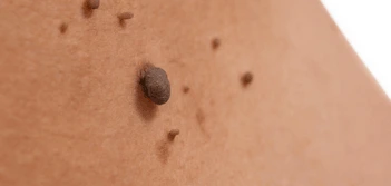 image of a skin tag Grimsby