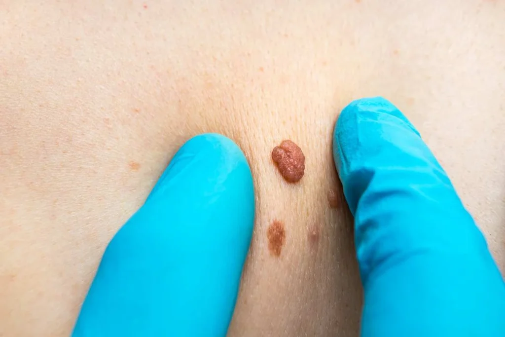 Consultant examining a skin tag Grimsby