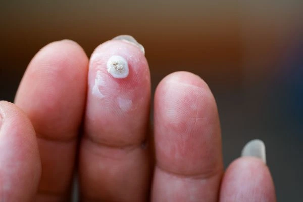 wart on person finger - cryotherapy to treat from LA LIPO Grimsby