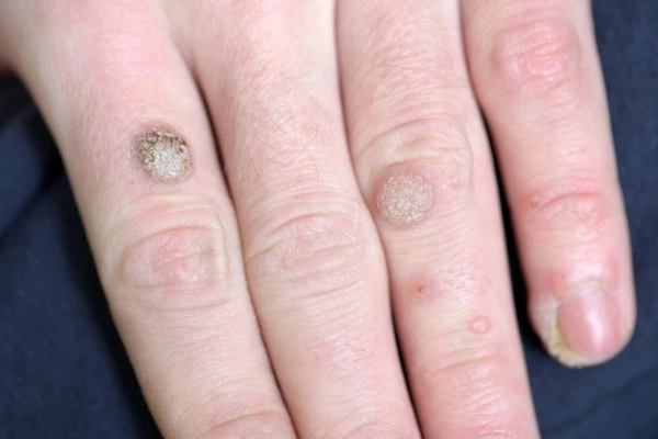 photo of warts on person hand - see wart removal Grimsby from LA LIPO