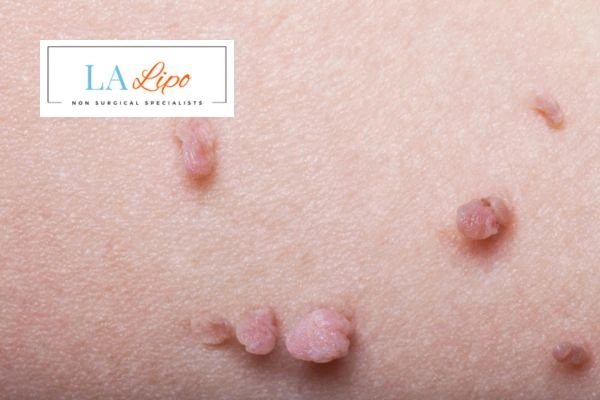 Does cryopen skin tag removal Grimsby hurt? Find out now call our team today!
