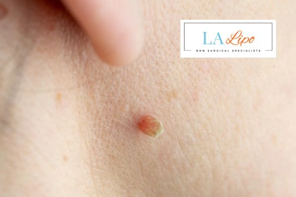 Book skin tag removal Grimsby today speak to our team now!