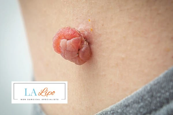 Interested in skin tag removal Grimsby? Concerned about the pain? Find out more today!
