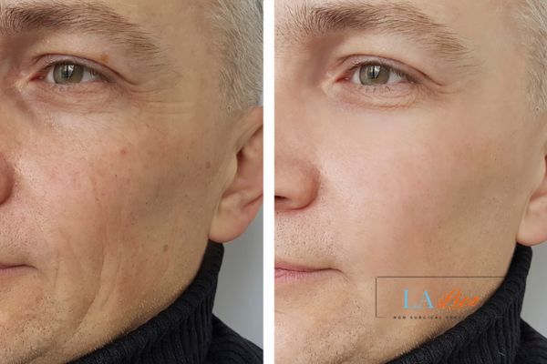 See the amazing results of Morpheus8 Treatment Grimsby!