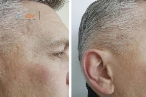 Mens Before & After Morpheus 8 Results Grimsby