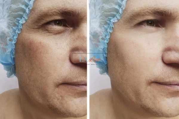 Before and after Morpheus 8 Results Grimsby