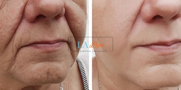 Older lady deeper wrinkle reduction - LA LIPO Morpheus 8 Results Grimsby