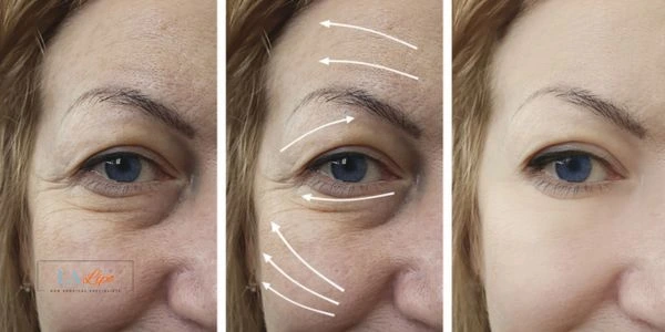 Amazing eye lift Morpheus 8 results Grimsby