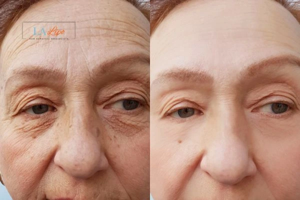 The powerful benefits of Morpheus8 Treatment Grimsby - Call Our team today!