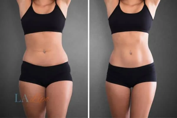 before and after results of non-surgical treatment to help a woman's body image and mental health Grimsby