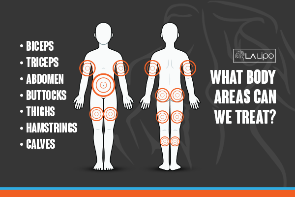 Diagram to show areas you can have LA-EMS Body Sculpting Treatment Grimsby