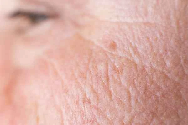 close up picture of a woman's face showing an age spot Grimsby
