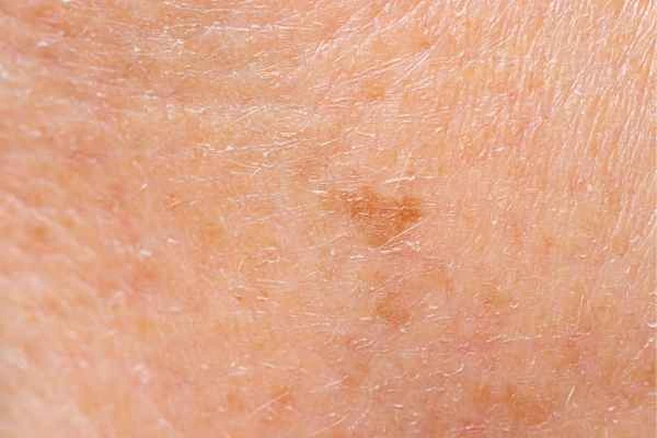 close up picture of age spots Grimsby