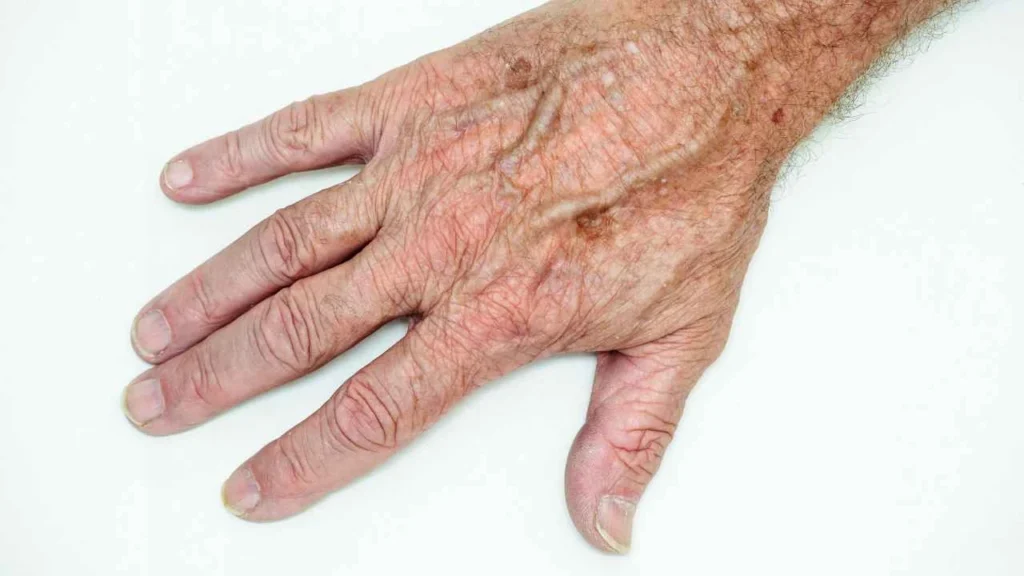 Male hand showing age spot Grimsby