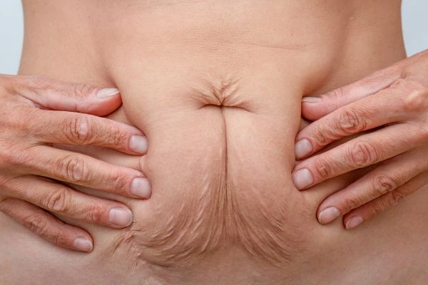 Image of a woman's stomach with loose skin - example of skin tightening Grimsby options