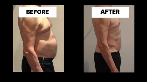 What Symptoms Can Diastasis Recti Cause in Men? Weak Core, Back Pain and Poor Posture Grimsby